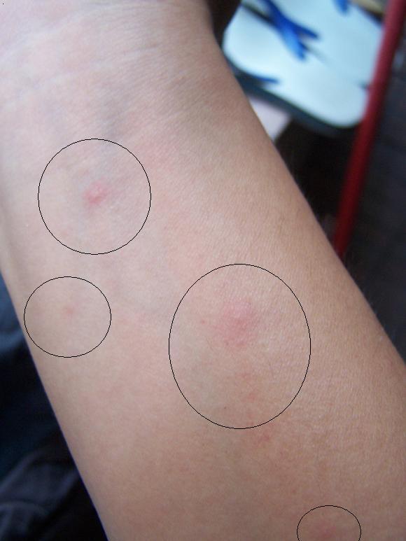 (一)潜伏梅毒潜伏梅毒是指已被确诊为梅毒患者,在某一时期,皮肤,粘膜